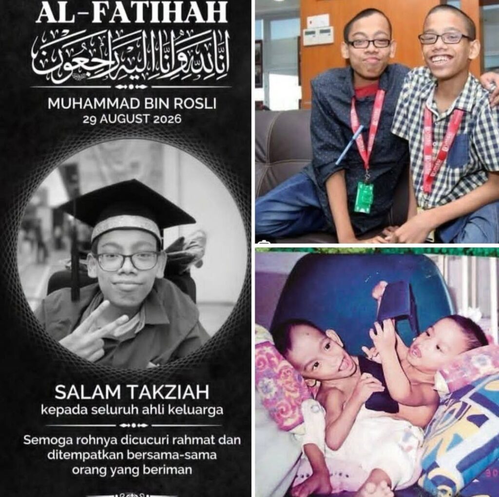 Kembar siam Muhammad meninggal dunia